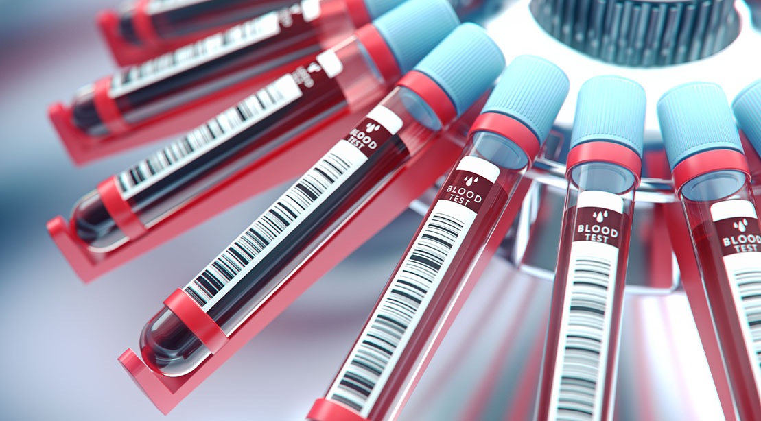 Blood in a centrifuge for testing toxicity as part of the EBO2 blood detoxifying therapy