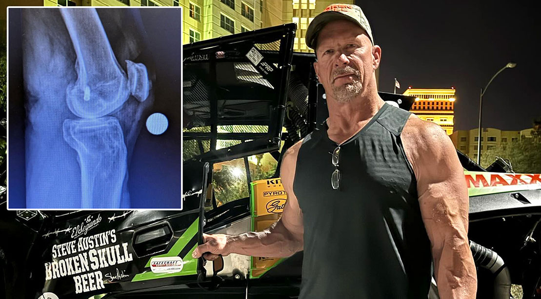X-Ray of Stone Cold Steve Austin's knee before his knee surgery